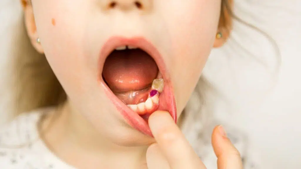 bpa free Tooth-colored Fillings
